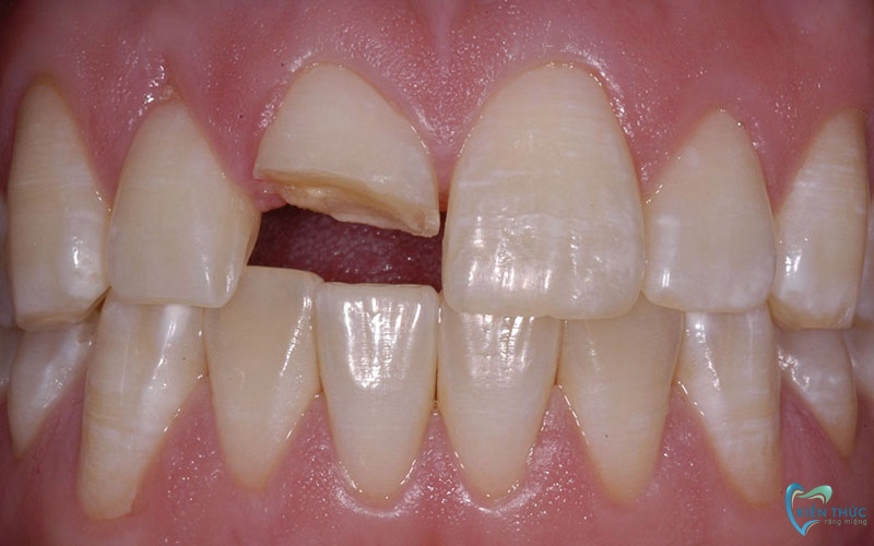 Răng bị vỡ không sử dụng phương pháp bọc răng sứ không mài