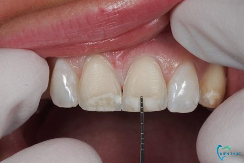 Chỉ mài tầm 0,3mm nên không ảnh hưởng đến răng thật 