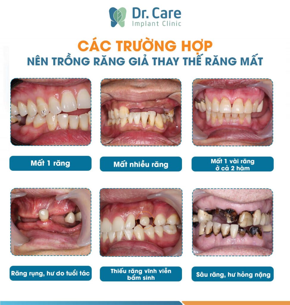 các trường hợp nên trồng răng giả 