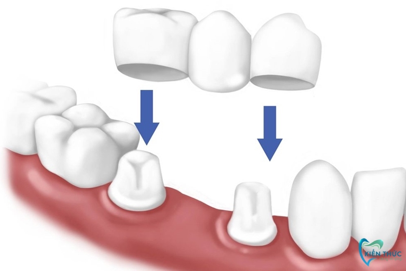 Cầu răng sứ truyền thống được sử dụng khá phổ biến