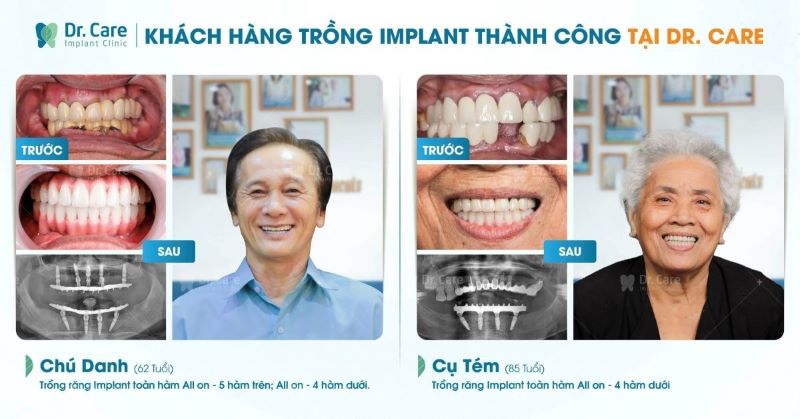 Top 10 nha khoa có giá trồng răng Implant TP. HCM tốt nhất 2023