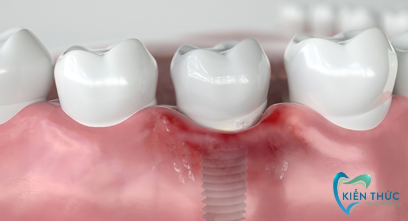 Có nên trồng răng Implant giá rẻ?