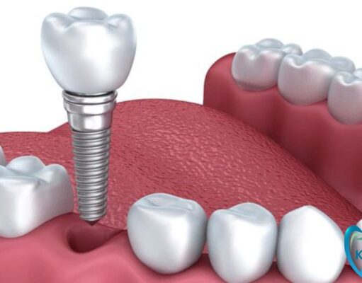 [GIẢI ĐÁP THẮC MẮC] - Trồng răng Implant giá bao nhiêu 1 cái?