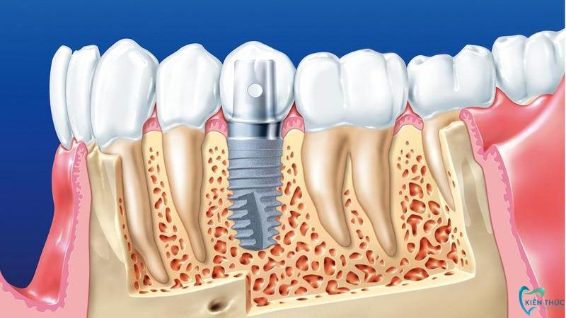 Trồng răng Implant là phương pháp phục hồi răng mất hiệu quả và tốt nhất hiện nay