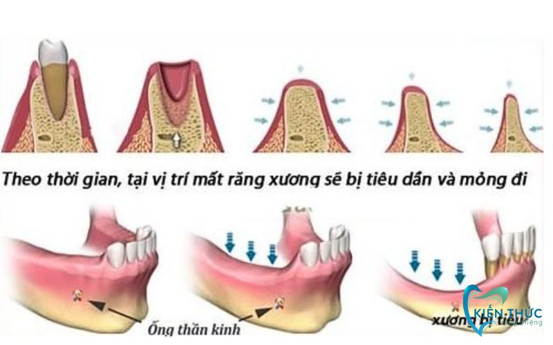 Tiêu chí lựa chọn trụ Implant dựa vào tình răng mất răng và xương hàm