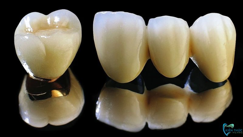 Loại răng sứ kim loại titan có giá thành tương đối rẻ nhưng độ bền không cao 