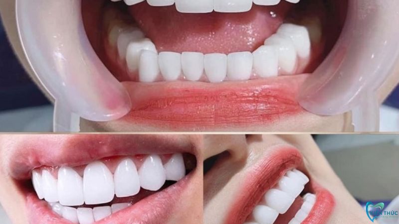 Bọc răng sứ mất khoảng 3-4 ngày đối với trường hợp bọc khoảng 2-3 chiếc răng