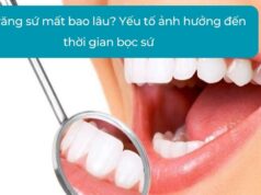 Bọc răng sứ mất bao lâu? Yếu tố ảnh hưởng đến thời gian bọc sứ?