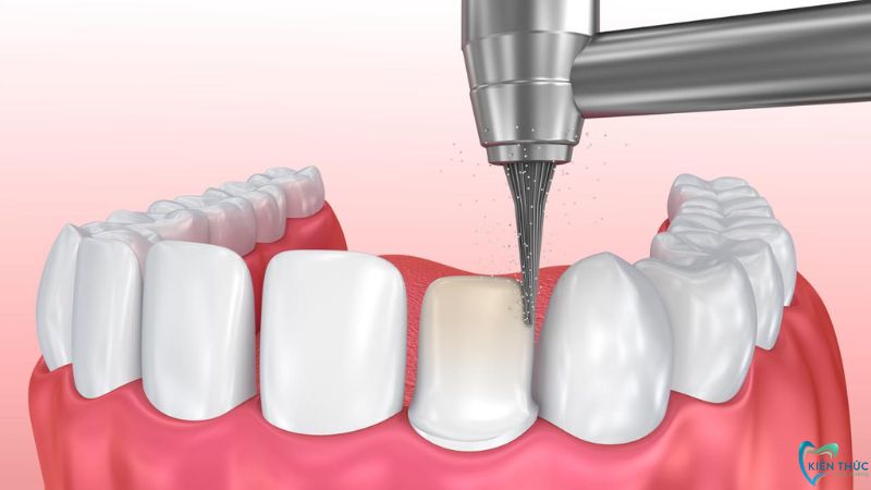 Mài cùi răng thật với tỷ lệ nhất định để làm trụ cố định phù hợp với phần răng sứ được chụp lên