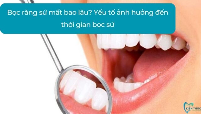 Bọc răng sứ mất bao lâu? Yếu tố ảnh hưởng đến thời gian bọc sứ?