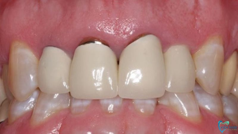 Khoảng cách giữa răng sứ và nướu bắt đầu xuất hiện sau thời gian dài sử dụng