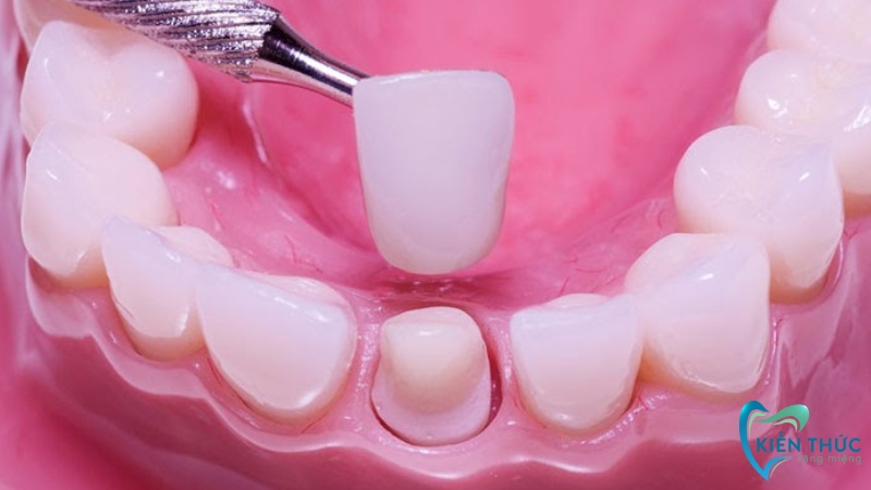 Quy trình bọc răng sứ được thực hiện như thế nào?