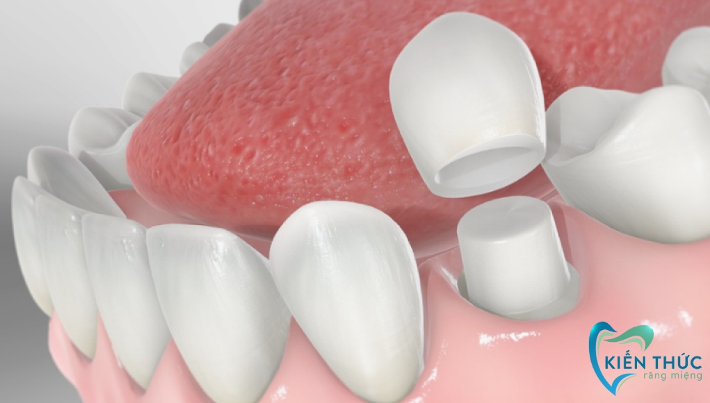 Quy trình bọc răng sứ an toàn và chuẩn nha khoa