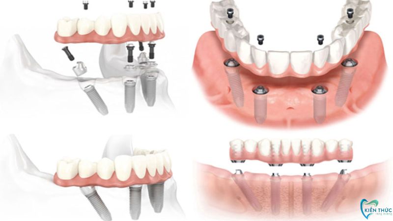 Răng giả tháo lắp hiện đại trên trụ Implant có độ bền cao, tính thẩm mỹ tự nhiên