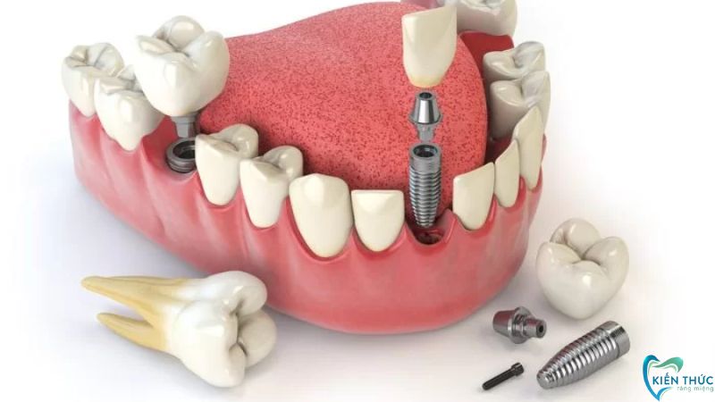 Trụ Implant Mỹ giúp phục hồi răng mất hiệu quả, đảm bảo an toàn khi sử dụng