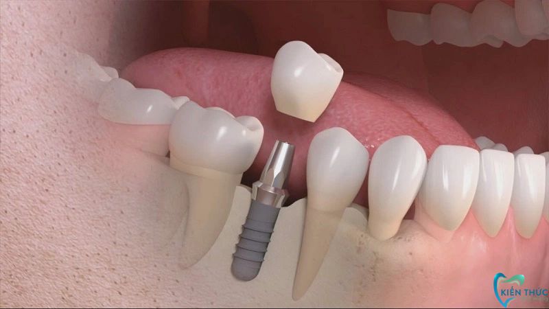 Implant Mỹ khắc phục tiêu xương hiệu quả khi cấy ghép vào môi trường khoang miệng