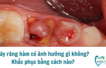 Gãy răng hàm có ảnh hưởng gì không?