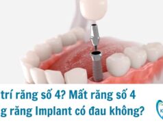 Mất răng số 4 trồng răng Implant có đau không?