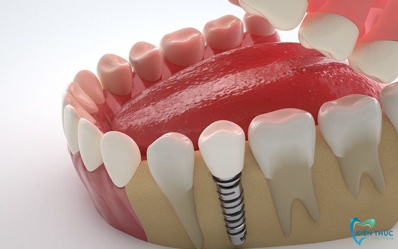Nên cắm Implant trong vòng 6 tháng mất răng để không gây đau nhức