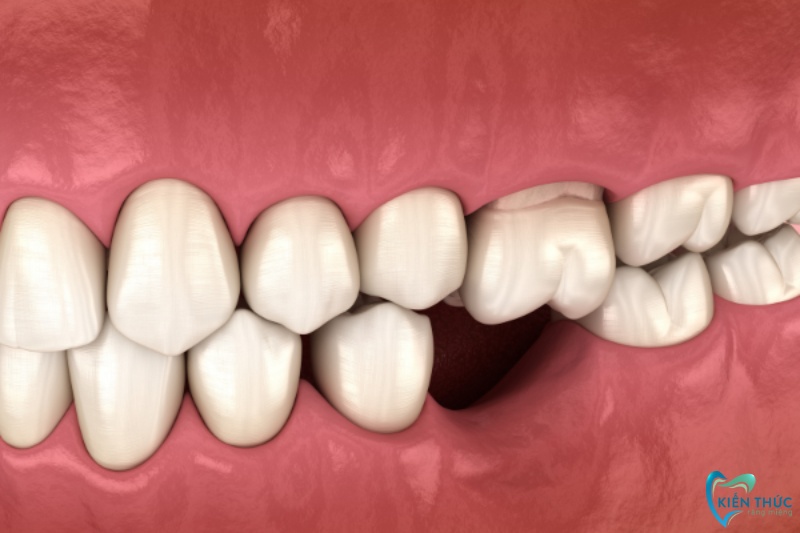 Trồng răng Implant ngay sau mất răng sẽ giúp ngăn chặn tình trạng tiêu xương