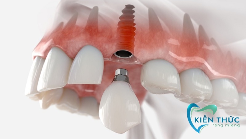 Vì sao chi phí trồng răng Implant ở các nha khoa lại khác nhau?