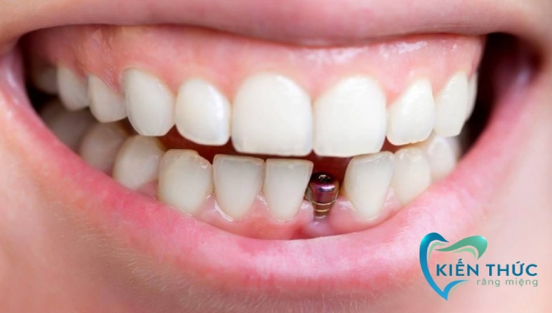 Trồng răng Implant tiết kiệm tại nha khoa chuyên sâu