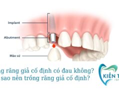 Trồng răng giả cố định có đau không? Vì sao nên trồng răng giả cố định?
