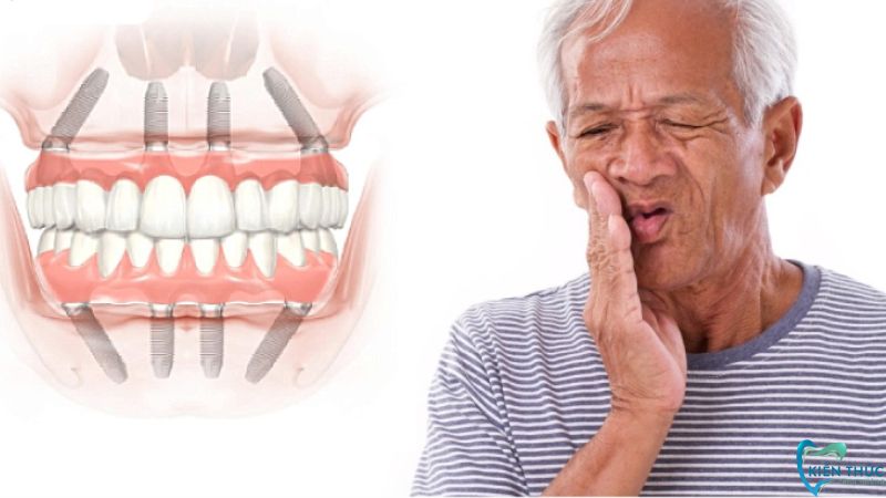 Mức độ đau răng sau khi cắm Implant sẽ khác nhau tùy thuộc vào tình trạng răng miệng của Cô Chú, Anh Chị