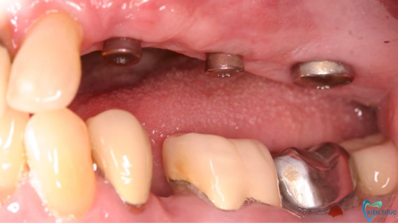 Thông số của răng sứ và hàm phục hình bị sai so với kích thước của vị trí răng mất gây đau nhức, khó chịu ở nướu