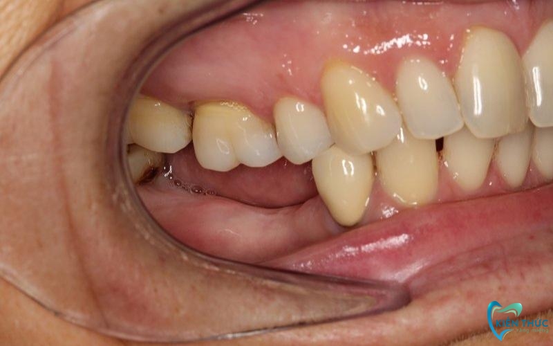 Mất răng lâu ngày dễ dẫn đến tiêu xương