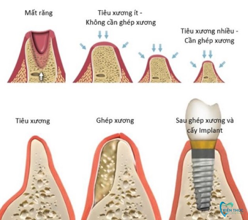 Ghép xương trồng răng Implant không gây đau đớn