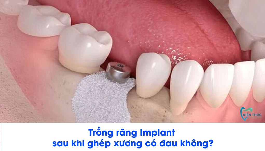 Trồng răng Implant bị tiêu xương