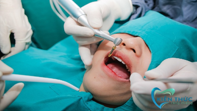 Nên lựa chọn trồng răng Implant trả góp hay trồng răng Implant giá rẻ?