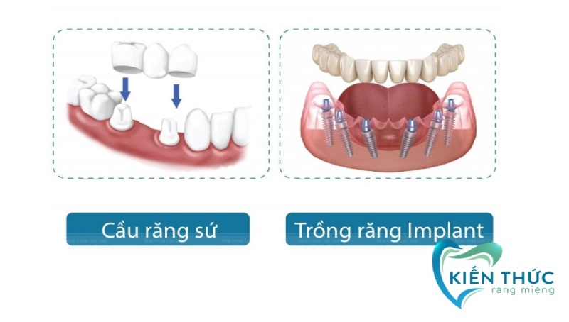 Đánh giá mức độ đau giữa trồng răng Implant và bọc răng sứ