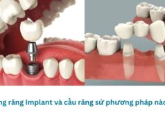 Trồng răng Implant và cầu răng sứ phương pháp nào tốt?