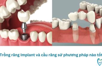 Trồng răng Implant và cầu răng sứ phương pháp nào tốt?
