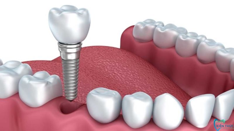 Trụ Implant Hàn Quốc thường được khuyên dùng trong trường hợp mất răng đơn lẻ