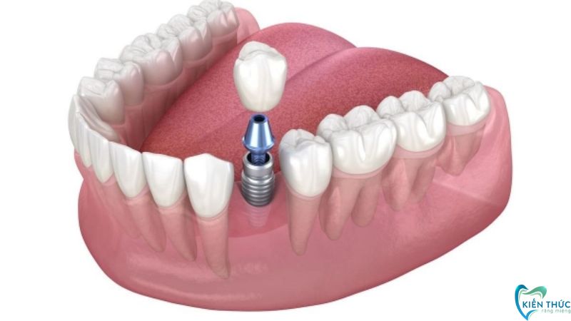 Nếu xương hàm và nướu răng vẫn còn tốt sau mất răng thì đáp ứng tốt điều kiện cấy ghép Implant