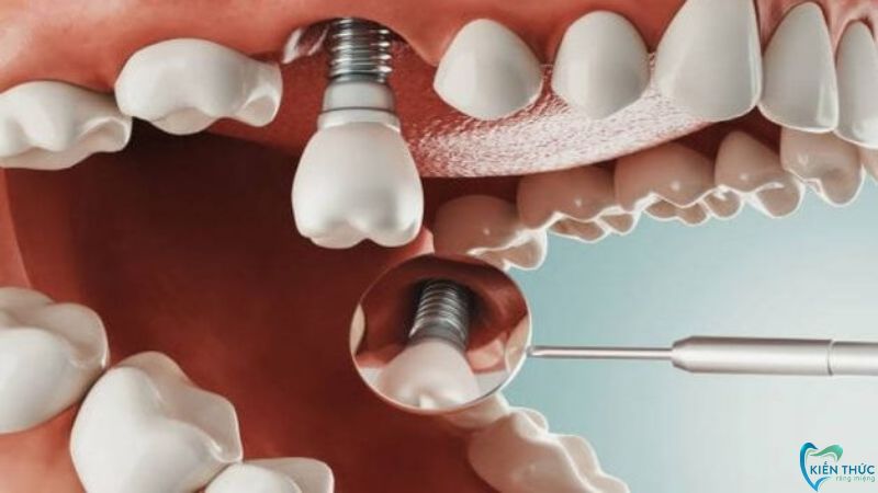 Cấy trụ Implant sau khi mất răng từ 1-3 tháng để đảm bảo hiệu quả phục hồi tối ưu nhất