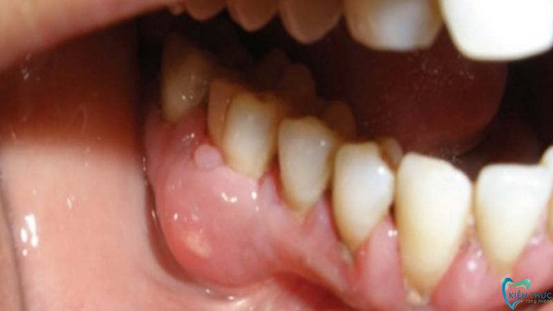 Răng số 6 bị lung lay do viêm nướu, vi khuẩn gây nguy hiểm đến răng
