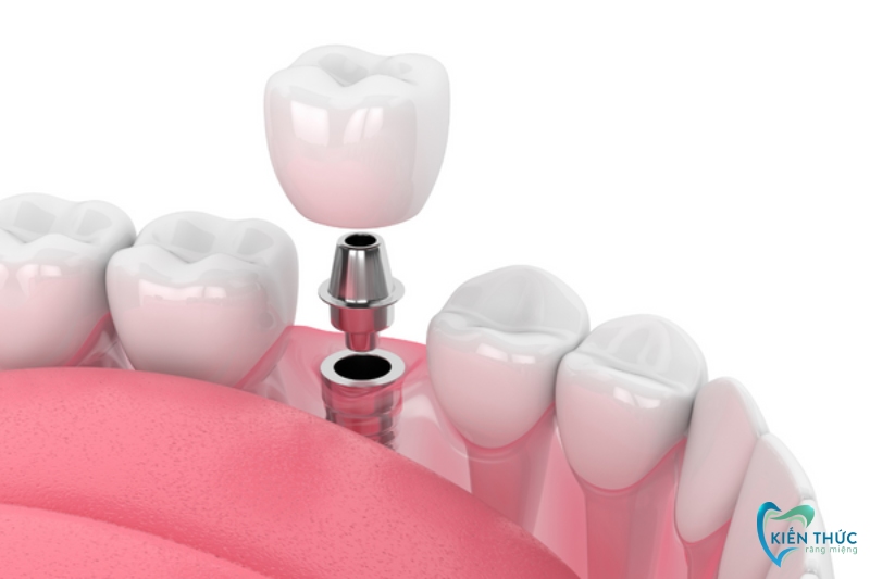 Cấy ghép Implant là phương pháp phục hình răng số 6 hiệu quả