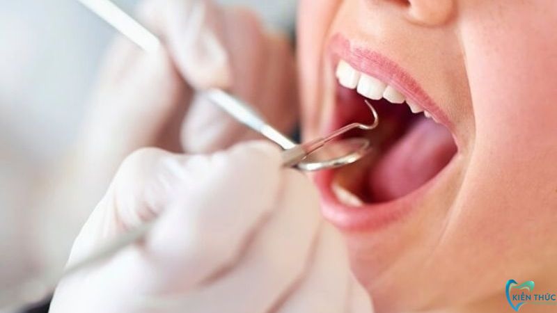 Bác sĩ lấy cao răng để nhằm giúp khắc phục tình trạng sưng mộng răng khôn