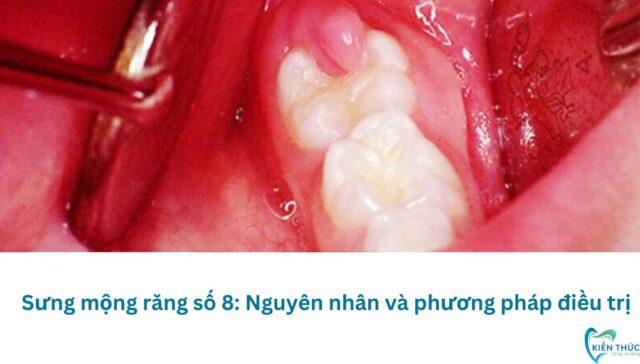 Sưng mộng răng số 8: Nguyên nhân và phương pháp điều trị