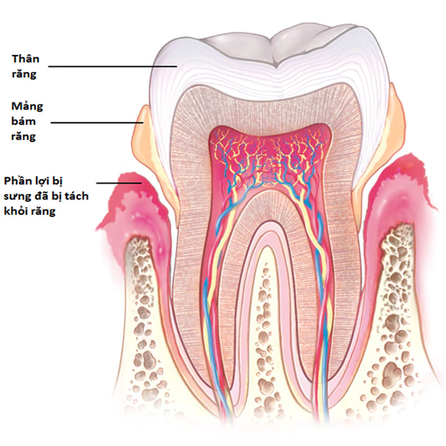 Cách điều trị viêm nha chu hiệu quả