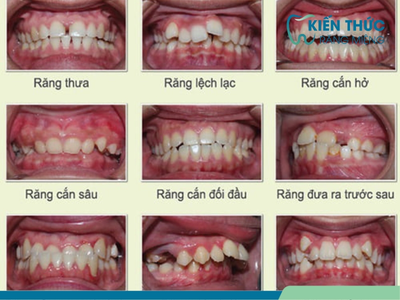 10 bệnh răng miệng nguy hiểm gây mất răng