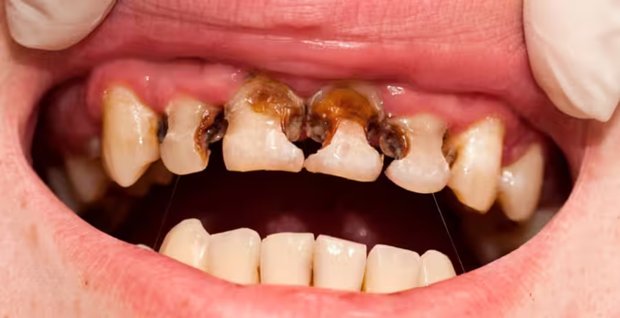 bệnh răng miệng nguy hiểm - Sâu răng và biến chứng nguy hiểm