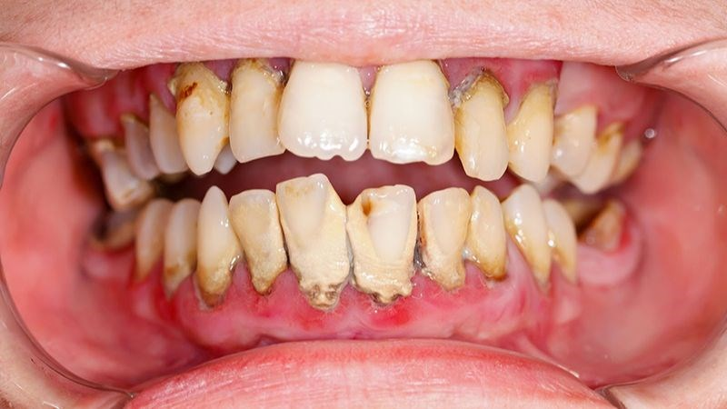 bệnh răng miệng nguy hiểm - Viêm nha chu