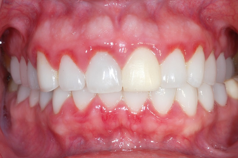 Dấu hiệu cảnh báo sớm - sưng nướu
