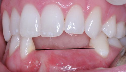 Mất Răng Hàm Dưới Có Ảnh Hưởng gì