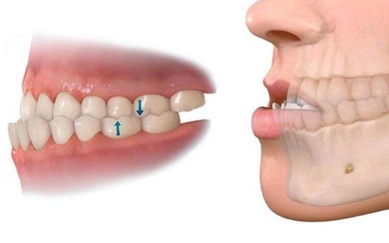 hàm bị lệch làm mặt méo